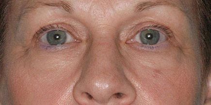 Non-Invasive Skin Rejuvenation