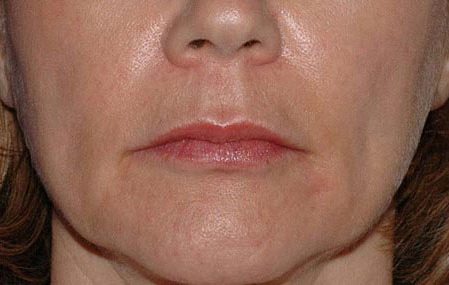 Juvederm and Restylane