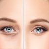 blepharoplasty