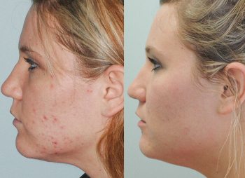 Acne in Kernersville, North Carolina