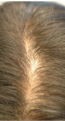 Hair Restoration