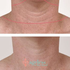 10 Ways to Minimize Wrinkles Caused by Tech Neck