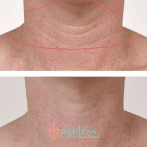 10 Ways to Minimize Wrinkles Caused by Tech Neck 