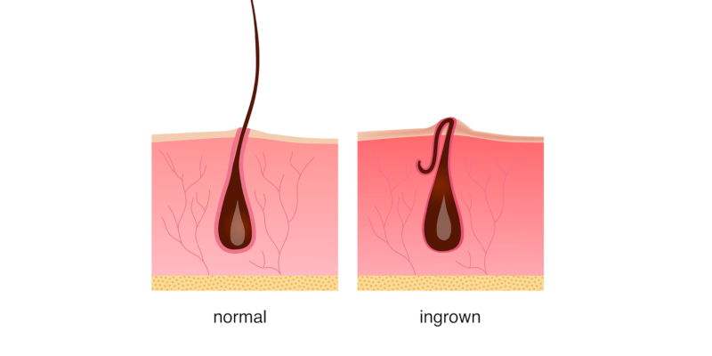 Ingrown Hairs: How to Treat Them Professionally to Prevent Infection -  Ageless in the Triad Med Spa