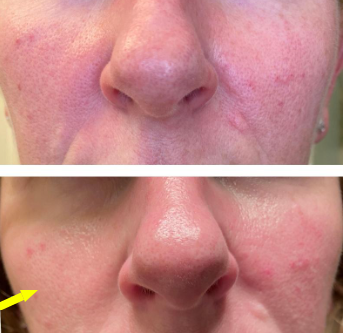 What Is Rosacea and How Can it Be Treated?