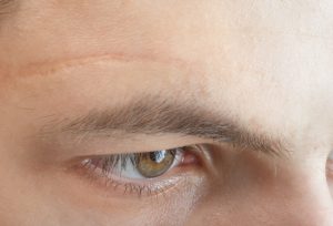 How to Reduce the Appearance of Scars