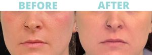 Discover the Sciton Moxi Laser: A Gentle Way to Rejuvenate Your Skin
