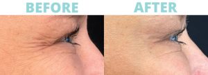 What Is Botox?