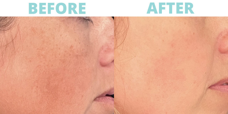 Profractional Therapy in Kernersville, North Carolina