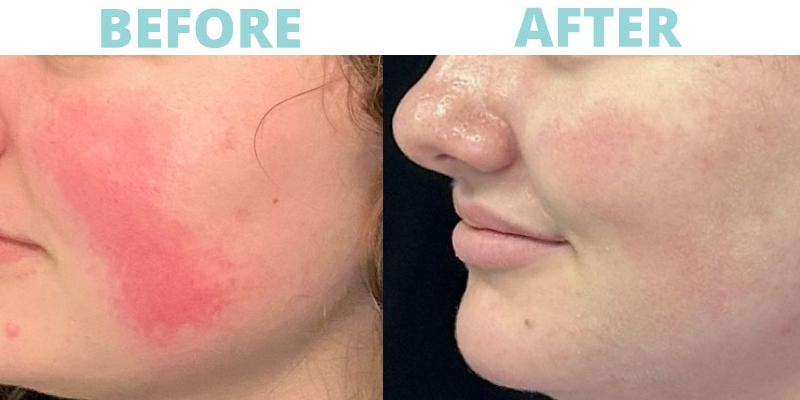 ClearSilk™ in Kernersville, North Carolina