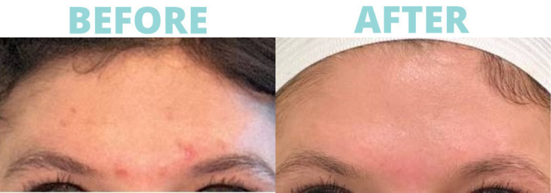 BBL Herioc section_res BBL PHOTOFACIAL