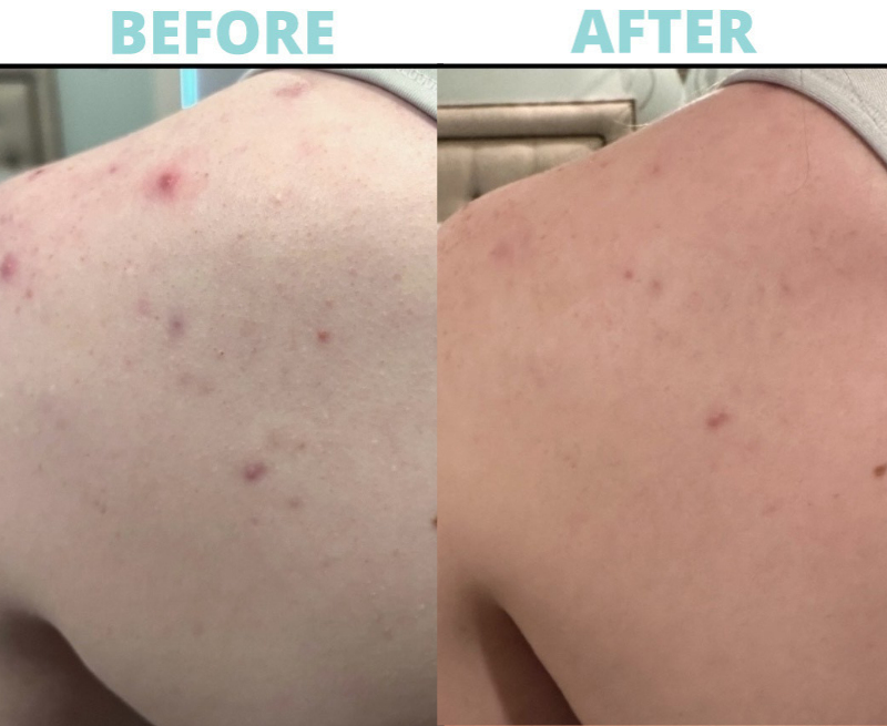 Back Hydrafacial OBAGI