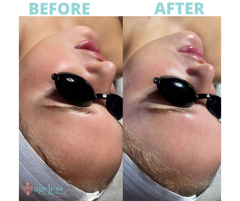 hydrafacial