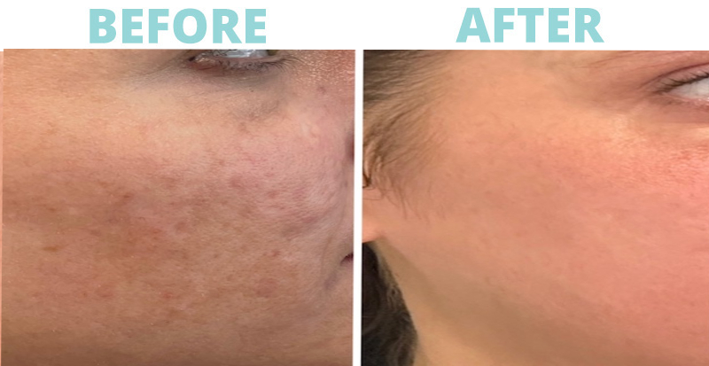 moxi-resnew Moxi Laser Treatment