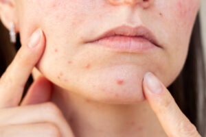 How To Manage Acne