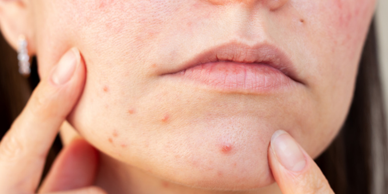 How To Manage Acne