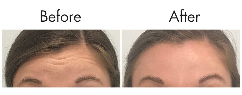 Looking Natural With Botox & Other Neuromodulators